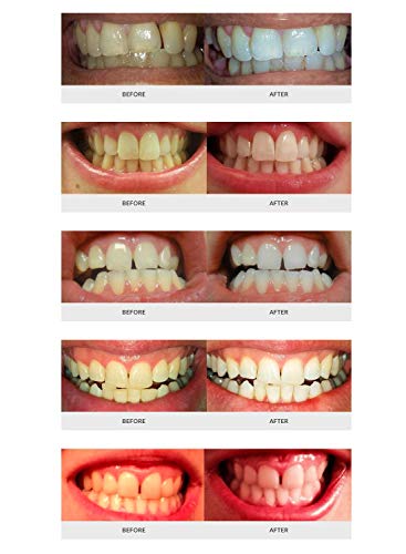 AuraGlow Teeth Whitening Kit with LED Light, (2) 5ml 35% Carbamide Peroxide Gel Syringes, Tray and Case