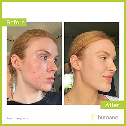 DermaHarmony Maximum-Strength Acne Wash (10% Benzoyl Peroxide) - 8 Fl Oz - Non-Foaming Cleanser for Face, Skin, Butt, Back & Body - Dermatologist-Tested, Vegan & Cruelty-Free.