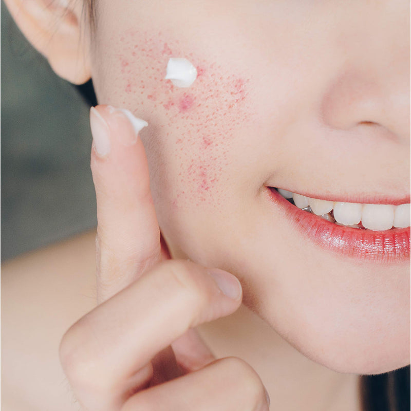Neutrogena Rapid Clear Maximum Strength 10% Benzoyl Peroxide Spot Treatment Gel for Acne Prone Skin, 1 oz
